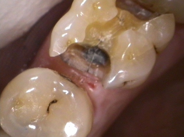 Cracked tooth